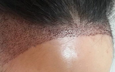 种植发际线有什么后遗症(种植发际线对身体有影响吗？)
