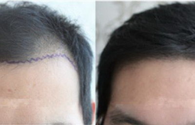 头发际线稀疏一般植发际线多少钱