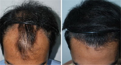 头发种植手术山西哪里有_头发种植图片