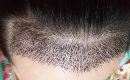 植发的手术需要多久_成都植发不剃发