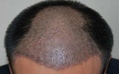 种植发际线会不会影响智力(什么是种植发际线手术？)