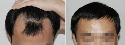 总是掉头发怎么治疗_杭州掉头发专科医院