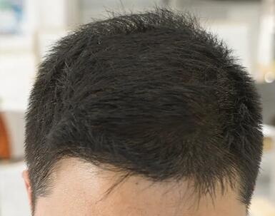 内分泌失调导致头发稀疏