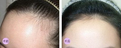 上海头发种植医院_头发种植方法图解