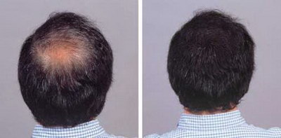 头发少有白发怎么办？专家教你如何防止脱发延缓白发生长