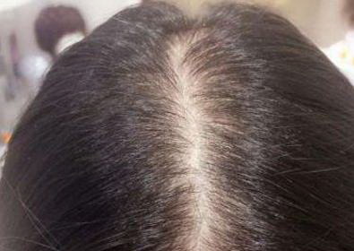 植发对人的身体影响大吗_植发安全吗?究竟有无副作用?