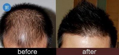 FUT植发：最具性价比的头发移植技术