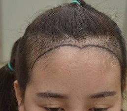 广州植头发的价格_怎样手术种植头发