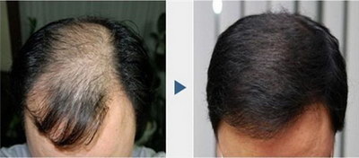 无锡植发医院：提供高效安全的头发移植服务
