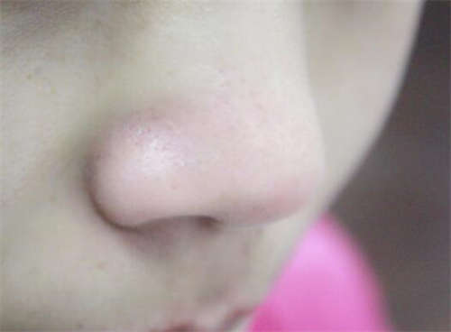 芜湖市芜湖县鼻孔改型排名前五前三整形医生分享给你